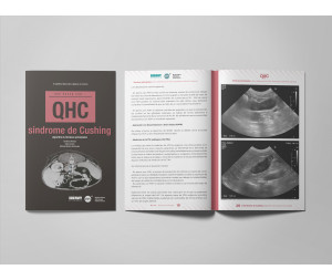Revista QHC Síndrome de Cushing